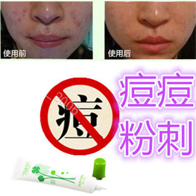 正品去除面部男女修复精华霜痘痘豆豆痤疮酒糟鼻产品前胸后背额头