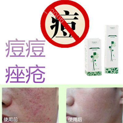 正品植物面疮酒刺胸前豆豆油性粉刺立消去除青少年痘痘全清修复液