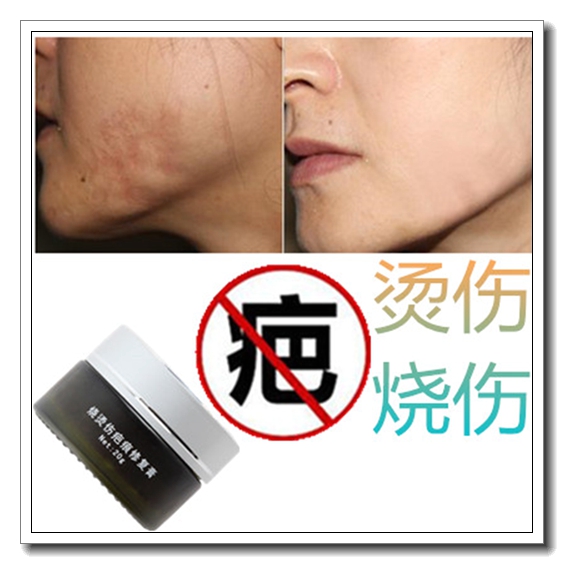 去除手术儿童增生凹凸疙瘩祛烧伤药烟烫疤痕印淡化激光缝针黑色素