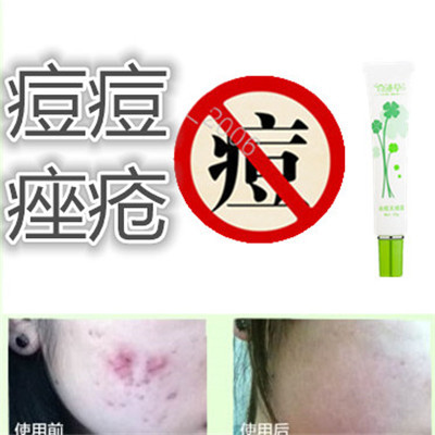 药用消除去面疮前胸后背酒刺豆豆痘痘立清痘痕平脂肪粒防敏感痤疮