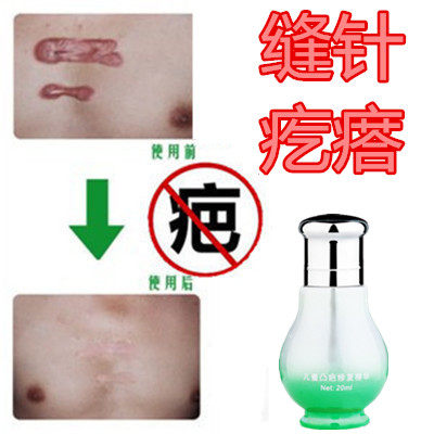 草本药用去剖宫产烟烫疙瘩消除祛缝针产后手术凸出开刀伤疤痕印液