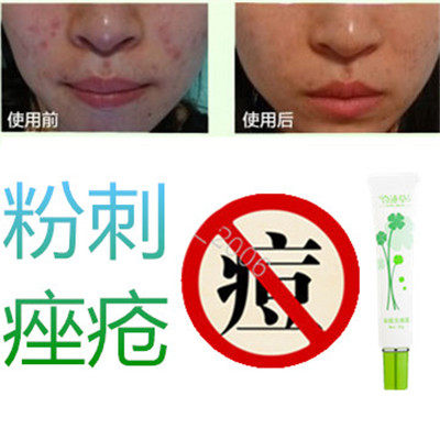 正品草本植物暗疮印酒刺痤疮祛男女封闭合性痘痘去除胸前痘痕豆豆