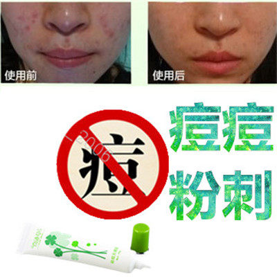 正品去除面部痘痘痘痕修复霜去前胸痤疮后背青春痘额头酒糟鼻精华