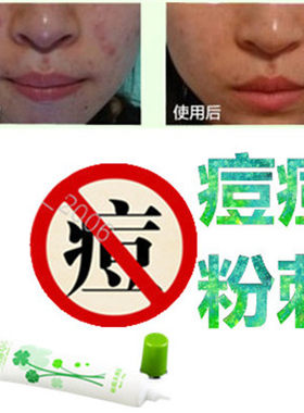 正品去除面部痘痘痘痕修复霜去前胸痤疮后背青春痘额头酒糟鼻精华