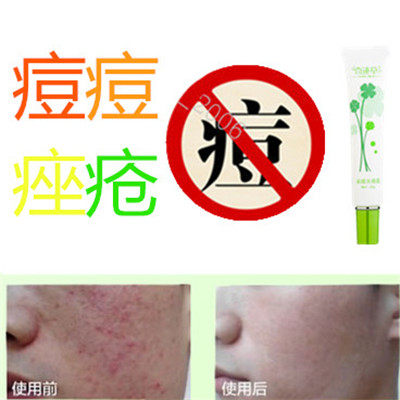 去额头油性痘痕清除后背暗疮痤疮膏正品修复液青春痘祛闭合性豆豆