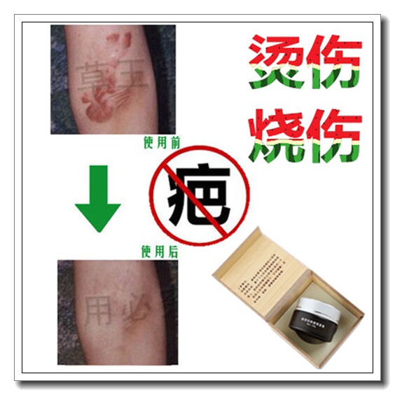 去除儿童冻疮疙瘩修复烟烫烧伤黑色素沉着祛增生性凹凸疤手术巴痕