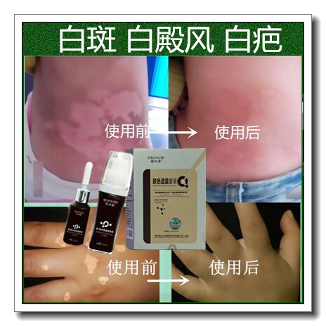 白殿风外用药软膏促黑色素生长液日本白疤白斑防水持久遮盖笔正品
