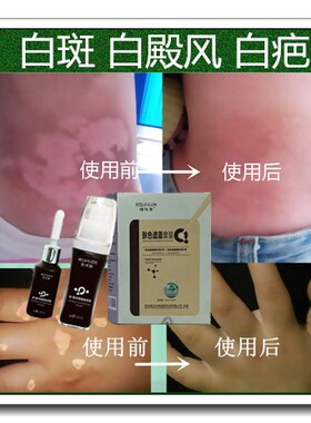 白殿风外用药软膏促黑色素生长液日本白疤白斑防水持久遮盖笔正品