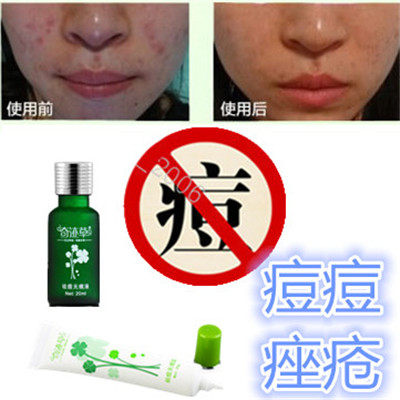 去后背部酒刺封闭合性痘痘粉刺酒糟鼻舒缓防敏感除祛前胸痤疮精华