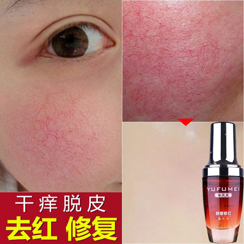 去红血丝修护增厚角质层淡化损伤舒缓敏感肌肤精华液褪红退红发烫