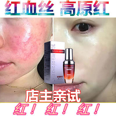 修护激素脸红血丝补水保湿乳液祛面霜淡祛除高原红苹果脸发红发热