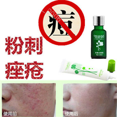 去除油性脂肪粒面疮酒刺舒缓敏感痤疮痘痘全清胸前豆豆粉刺平精华