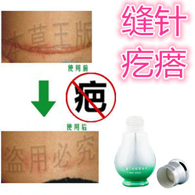 祛缝针修复剖宫产突疤疙瘩破腹产刀伤巴痕激光手术抓伤摔伤撞伤疤