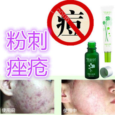 奇迹草本产品药用去除男女后背部封闭合性痤疮粉刺消除祛胸前暗疮