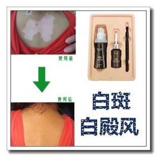 白殿风外用修护膏白斑净药膏白班修复液祛遮盖液霜剂遮瑕笔防水型