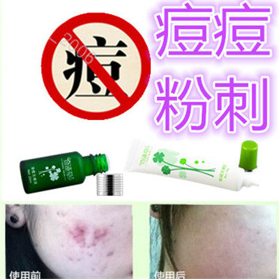 正品植物暗疮印疤痕酒刺痤疮青少年痘痘立消除去胸前豆豆油性粉刺