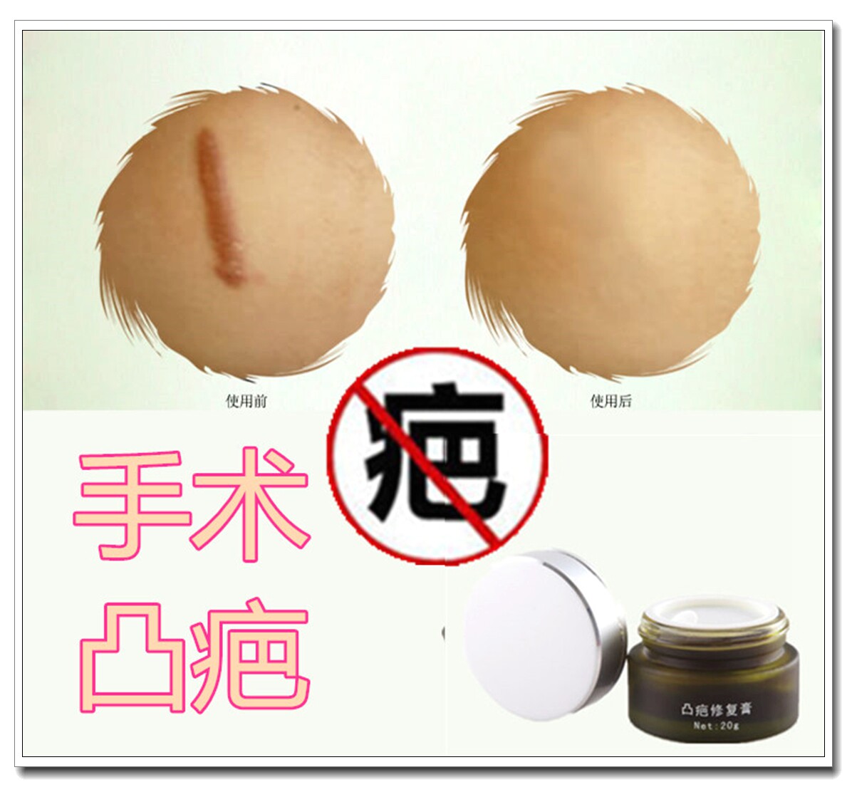 祛除耳洞硬疙瘩药膏去增生性疤痕体质修复凹凸起冻疮黑色素平巴贴