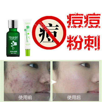 修复祛除后背上痘痘产品痘印痘疤青春痘豆豆淡化疤痕黑头痤疮男女