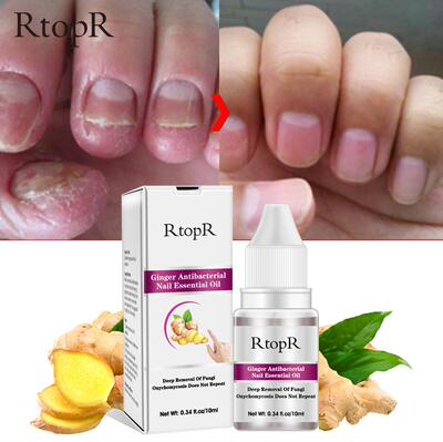 Ginger Antibacterial Nail Treatment Onychomycosis Paronychia