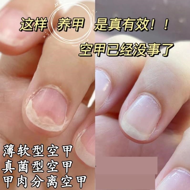 治指甲空甲修复液受损再生甲床甲肉分离专分层养剥增长生长手脚趾