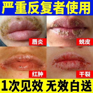 唇炎唇膏儿童嘴唇干裂脱皮专医用型口角炎专用剥落性修护药去死皮