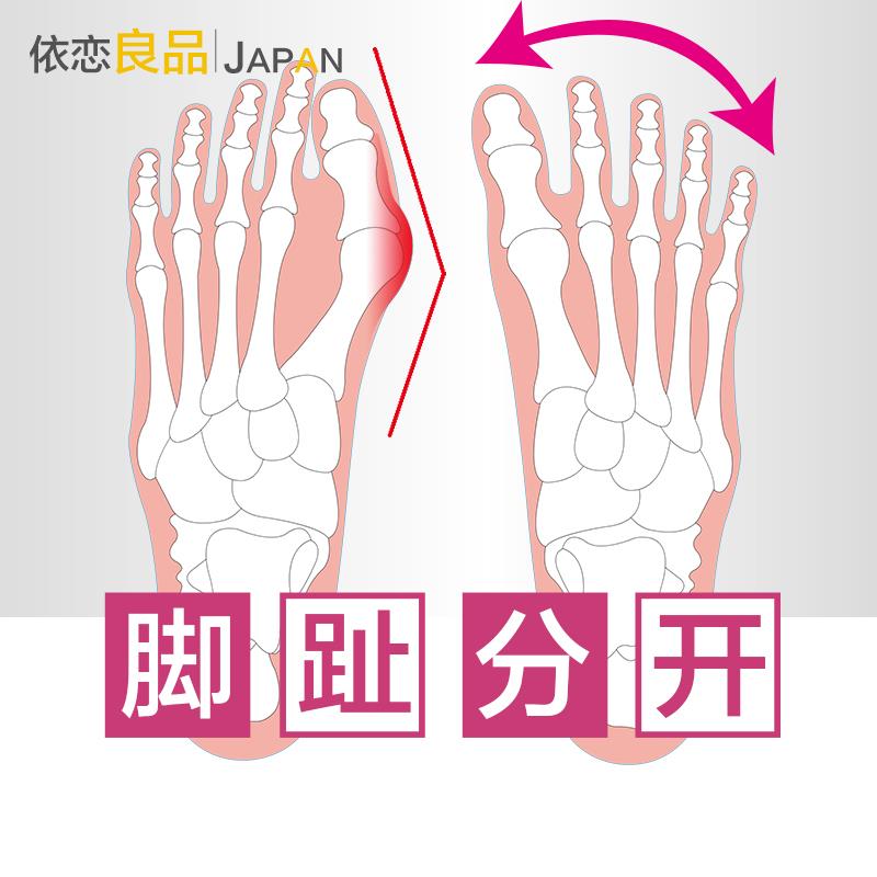 日本进口大拇指外翻脚趾矫正器重叠趾头纠正矫形大脚骨分趾器男女