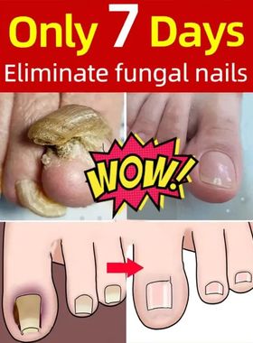 Nail Fungus Oil Soften Nail atment Oil for Weak Cracked