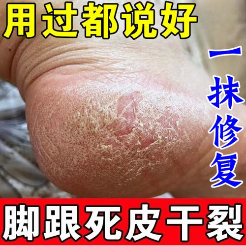 【山姆推荐】手脚指头干裂龟裂护理软膏脱皮痒裂冬季护足霜