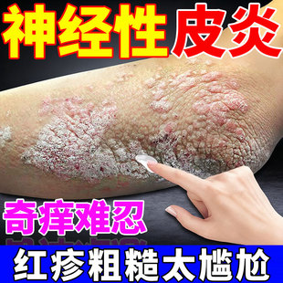 Dr.avin顽固神经性皮炎湿疹手肘眼皮阴囊效特搭专用止痒膏喷剂NP