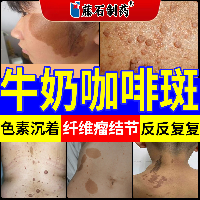 神经纤维瘤药监备案皮肤牛奶咖啡斑胎记膏儿童后背汗斑点淡化YU