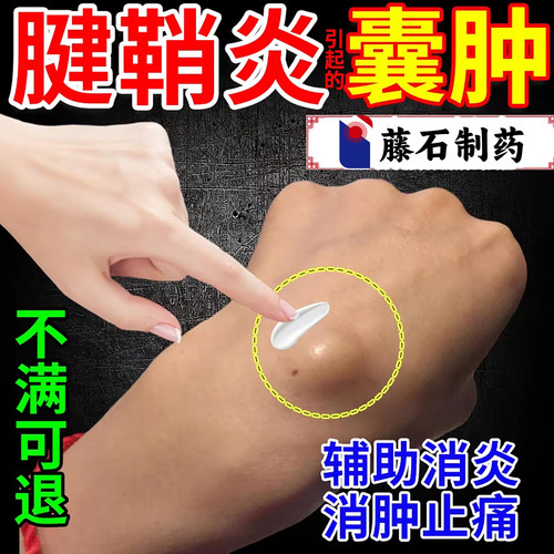 【千人见证】腱鞘囊肿鼓包