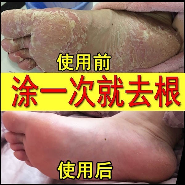 顽癣净 南洋珊瑚癣净 泡脚液草抑菌喷剂去除脚藓痒脱皮xj