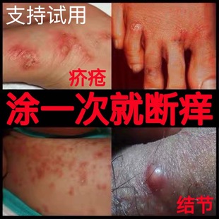 疥疮膏结不油腻去除阴虱疥虫螨私处止痒儿童成人疥苍特效专用药