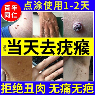 疣瘊肉粒一抹无忧猴子去除药膏