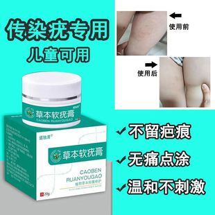 儿童传染性软疣儿童大人宝宝病毒性软疣水猴子软尤水瘊子药膏刮勺