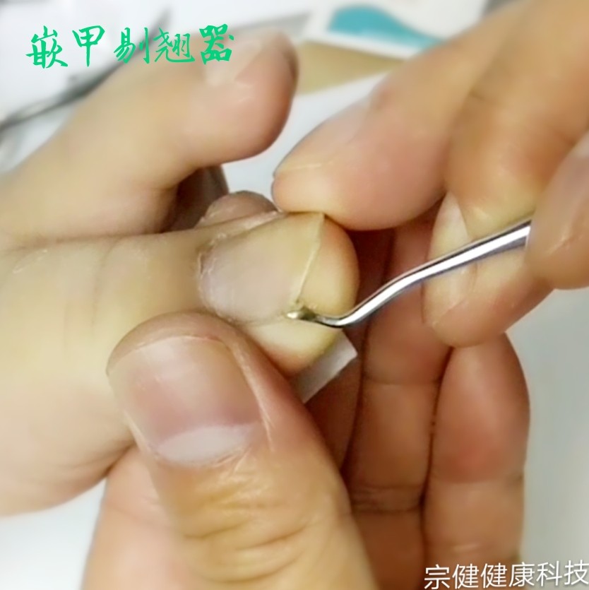 包邮家用指甲扎肉内生长嵌卷曲甲沟矫正指甲宗健剔翘器抬离矫正形