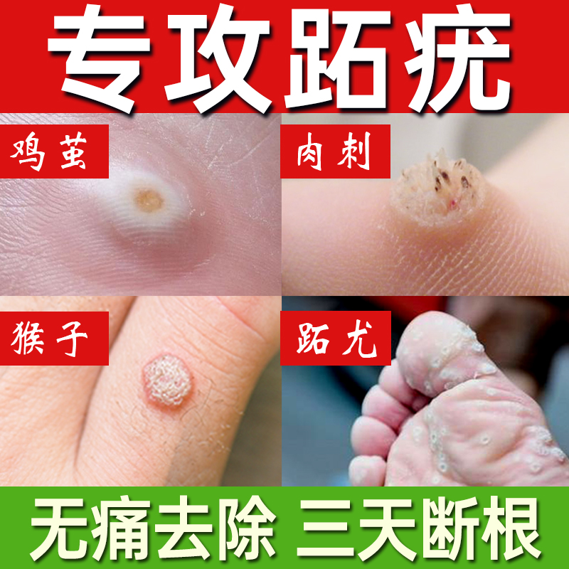跖疣膏寻常疣瘊肉粒去除神器非药膏足部根立净疣去除脚底专用日本