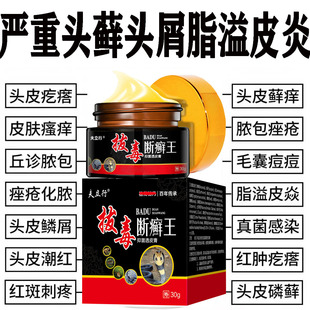 治头皮屑藓脂溢性皮炎牛皮银药去头部痒毛囊炎膏病真菌感染专用屑
