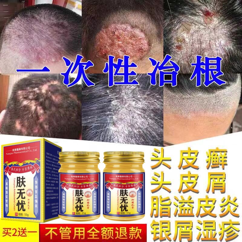 治头皮屑藓脂溢性皮炎牛皮银屑药头痒毛囊炎病真菌感染专用软膏
