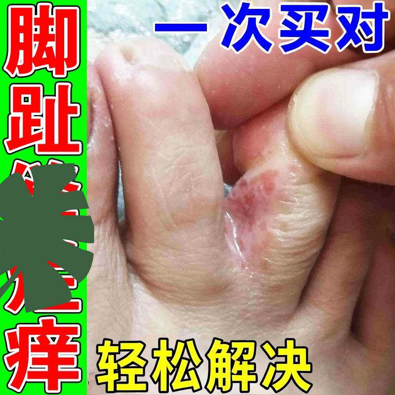 脚趾缝烂痒丫专用脱皮糜烂痒脚指缝溃烂水泡开裂