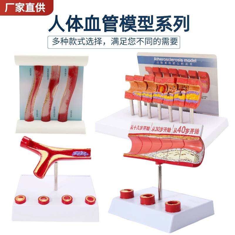 人体支脉粥样堵塞心血管模型血栓血液浓度脂肪病理粥样硬化解剖