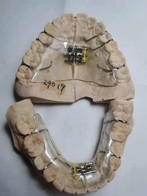 医院同款儿童扩弓器定制螺旋扩弓器牙齿功能性矫治器快速扩弓