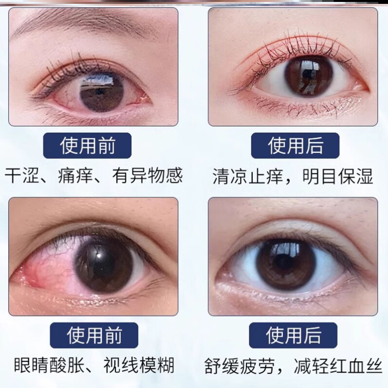 洗眼液清洁非抗菌消炎官方旗舰店正品止痒去黄红血丝缓解眼睛疲劳