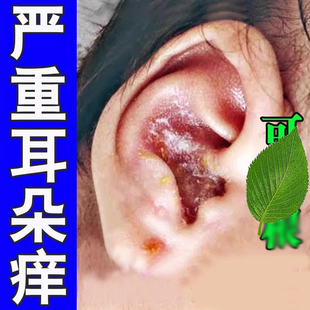 耳朵痒的外耳道干燥起皮专用膏