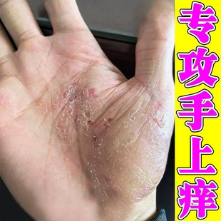 手痒膏手掌脱皮干裂痒起皮角化型专用乳膏