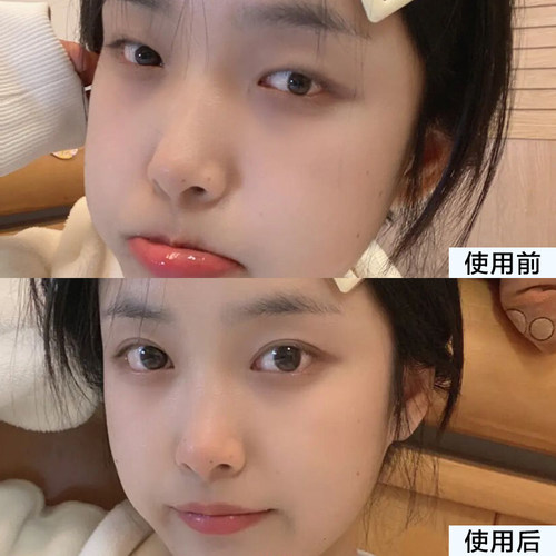 【10年双眼皮大牌】割眼皮不反弹