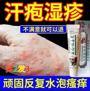 手上起小水泡汗?fàn)畎捳钪拱W漢狀真菌感染濕疹藥膏手癢脫皮干裂癬膏