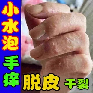 手痒水泡脱皮皮肤外用抑菌药手气反复干燥脱皮烂脚丫去股藓止痒膏