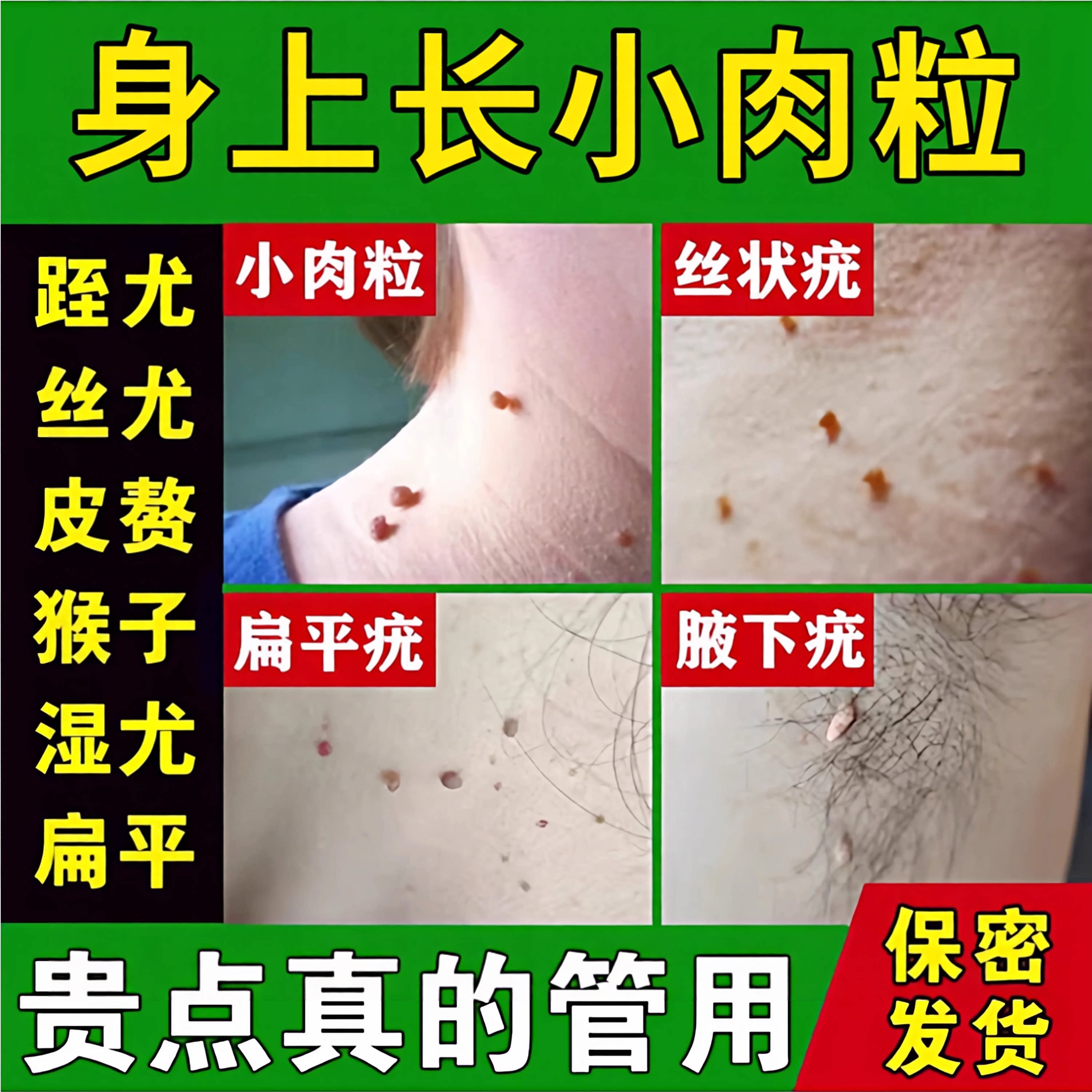 去脖子丝状疣小肉粒扁平尖锐湿疣冷热敷器具（器械）