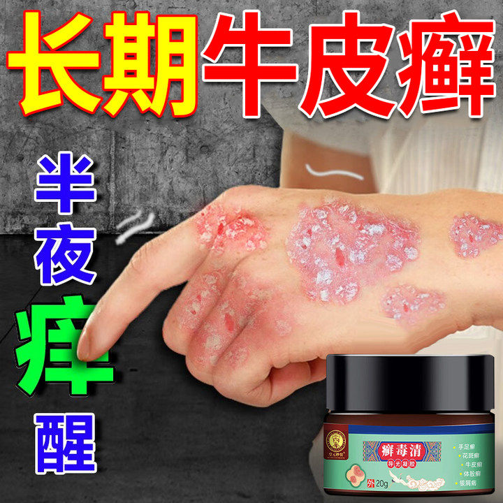 牛皮癣膏药贴真菌感染银屑病专手足用体癣头癣红斑丘疹瘙痒乳膏